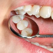 Dental Sealants in Dentistry