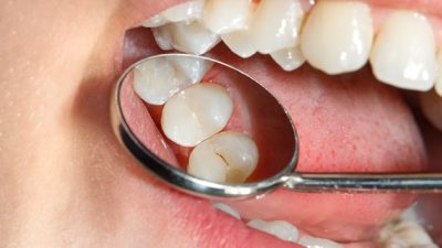 Dental Sealants in Dentistry Royal Dental Clinics Dental Sealants in Dentistry