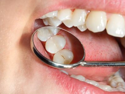 Dental Sealants in Dentistry
