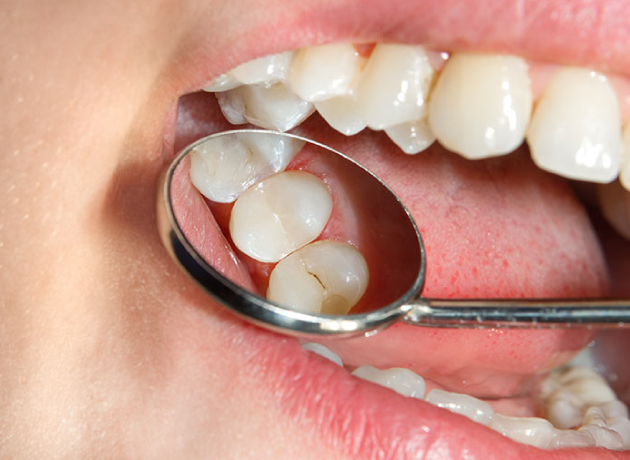 Dental-Sealants, teeth