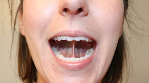 tongue tie in adult