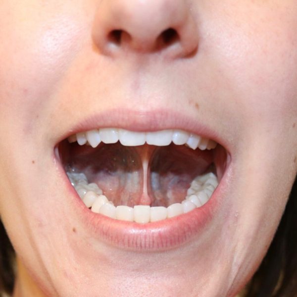 tongue tie in adult