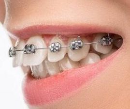 braces cosmetic dentistry