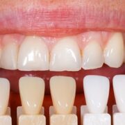 healthy teeth colour