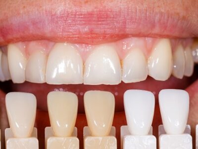 healthy teeth colour