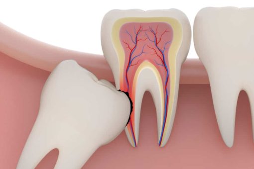 Wisdom tooth third molar