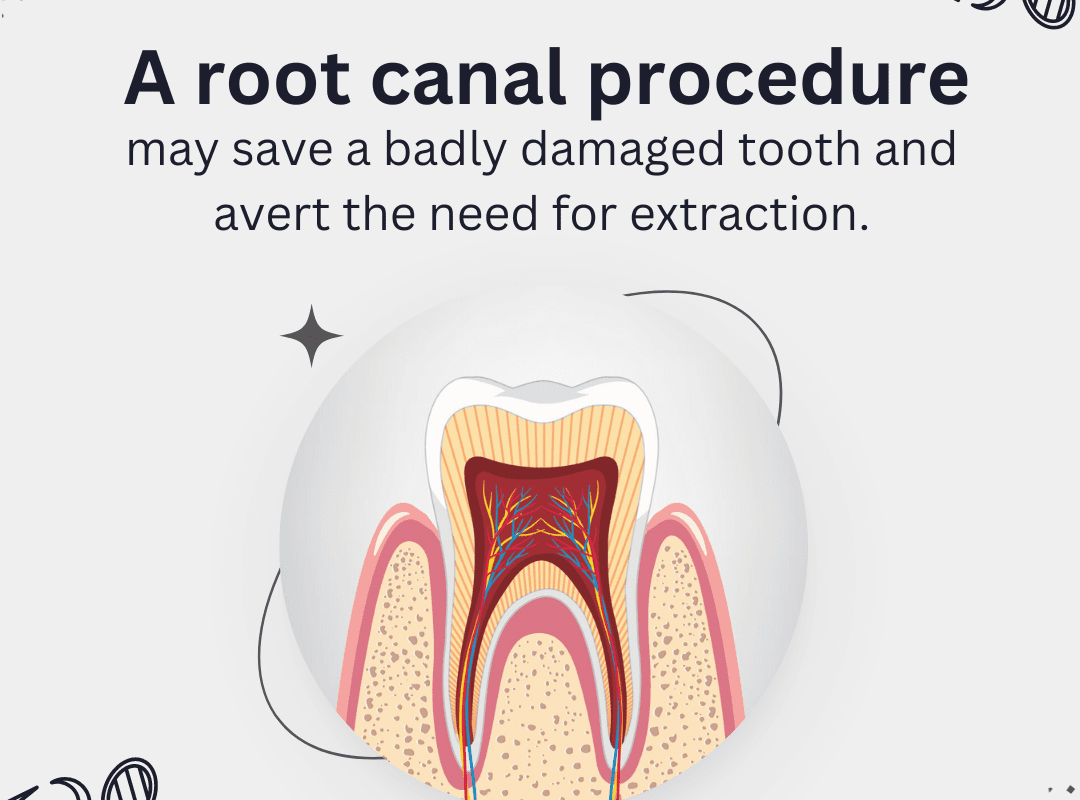 Multiple Root Canal Treatment Visit: When Is It Needed? Royal Dental Clinics Root Canal Crowns - multiple root canal treatment visit