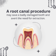 Root Canal Crowns - multiple root canal treatment visit