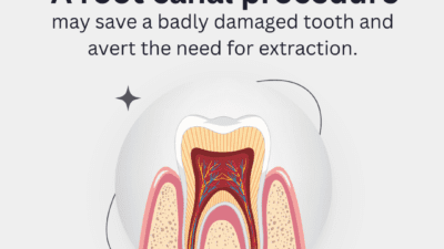 Root Canal Crowns - multiple root canal treatment visit