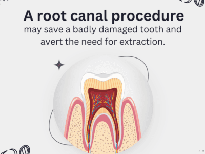 Multiple Root Canal Treatment Visit: When Is It Needed? Royal Dental Clinics Root Canal Treatment Root Canal Crowns - multiple root canal treatment visit