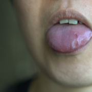 Tongue Cuts and Tongue Bites: Cause, First Aid When to see Dentist Royal Dental Clinics Tongue cuts and tongue bites