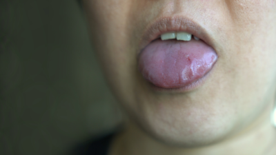 Tongue cuts and tongue bites