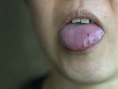 Tongue cuts and tongue bites