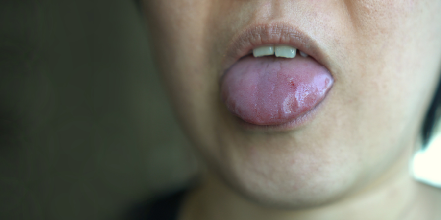 Tongue cuts and tongue bites