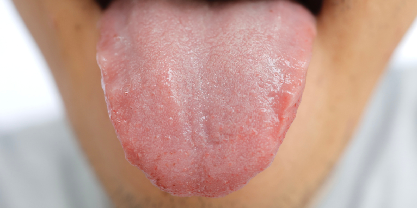 White Tongue Treatment: Cause, Symptom for White Layer on Tongue Royal Dental Clinics scalloped tongue - white tongue treatment