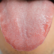 White Tongue Treatment: Cause, Symptom for White Layer on Tongue Royal Dental Clinics scalloped tongue - white tongue treatment