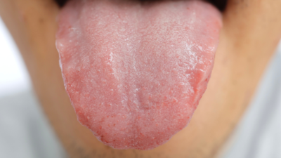 scalloped tongue - white tongue treatment