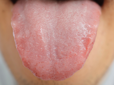 scalloped tongue - white tongue treatment