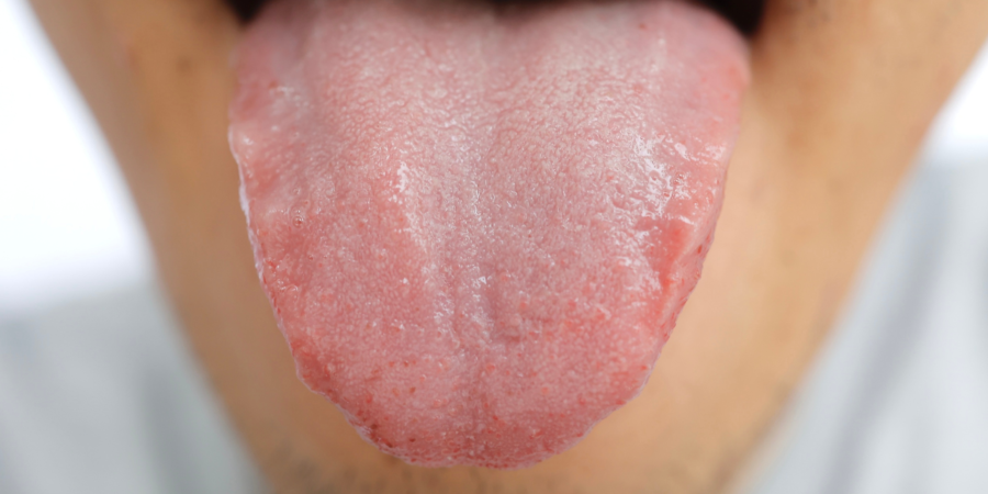 Scalloped Tongue: Causes and Treatment Royal Dental Clinics scalloped tongue