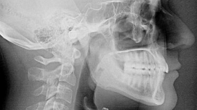 What is Atrophic Maxilla Zygomatic Implant Techniques? Royal Dental Clinics Extraoral x-rays near me | Royal Dental Care in Mumbai