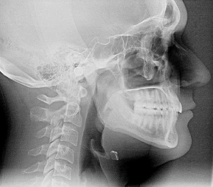 Extraoral x-rays