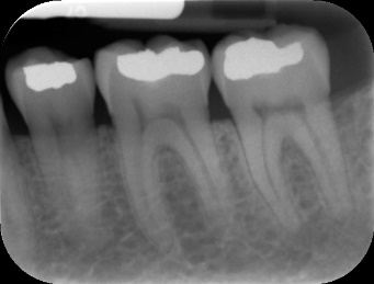 Periapical X-rays | Oral Health