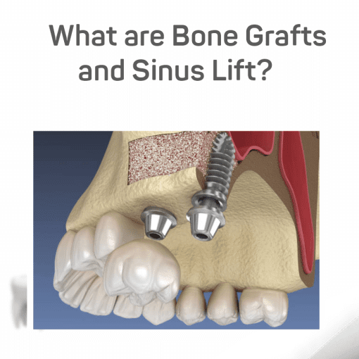bone grafts and sinus lifts