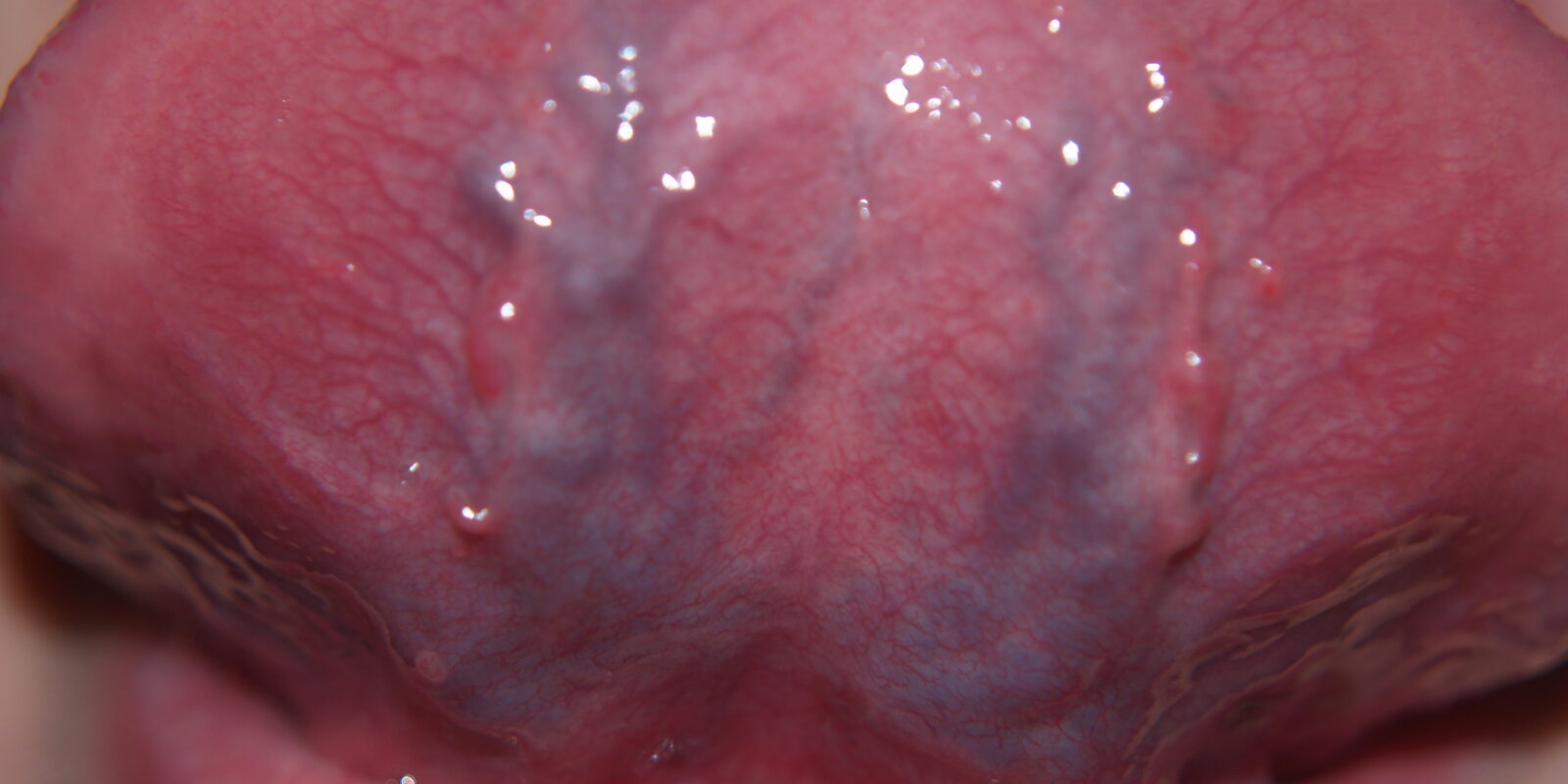Caviar Tongue: Cause, Dangers,When to See a Dentist Royal Dental Clinics Caviar Tongue Treatment