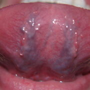 Caviar Tongue Treatment