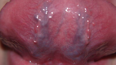 Caviar Tongue: Cause, Dangers,When to See a Dentist Royal Dental Clinics Dental Health Education Caviar Tongue Treatment