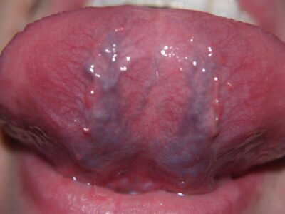 Caviar Tongue: Cause, Dangers,When to See a Dentist Royal Dental Clinics Dental Health Education Caviar Tongue Treatment