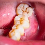 Do All Teeth Cavities need to a Filling? Royal Dental Clinics black fungus from teeth - Dental Plaque Detected