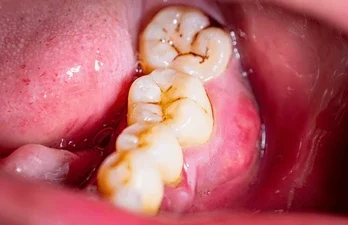 Black Fungus on Teeth or Black Stains? Cause, Risk, Treatment Royal Dental Clinics malocclusion black fungus from teeth