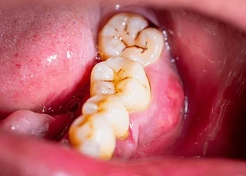 black fungus from teeth