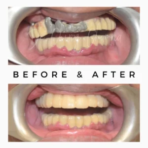 Before After Cosmetic Dentistry