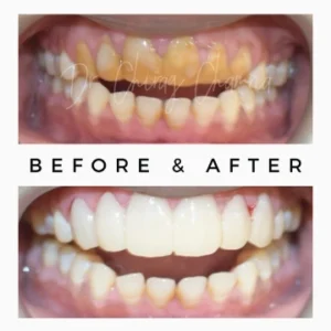 Before After Cosmetic Dentistry