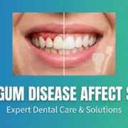 Teeth Mobility in Kandivali, Mumbai: How Gum Disease Affect Smile Royal Dental Clinics How Gum Disease Affect Smile