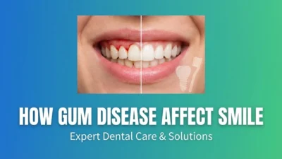How Gum Disease Affect Smile
