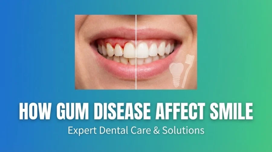 How Gum Disease Affect Smile - Dentist Treat Gingivitis