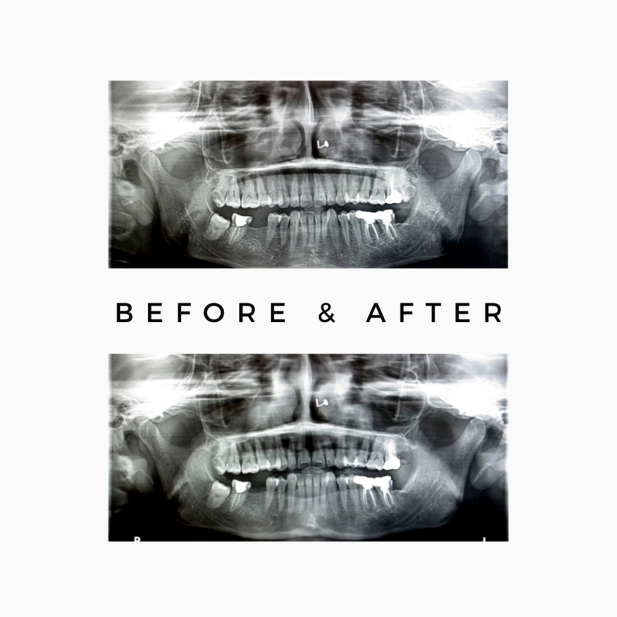 What is the recovery time after Molar Tooth Extraction in Mumbai? Royal Dental Clinics Dental Extraction Wisdom Tooth