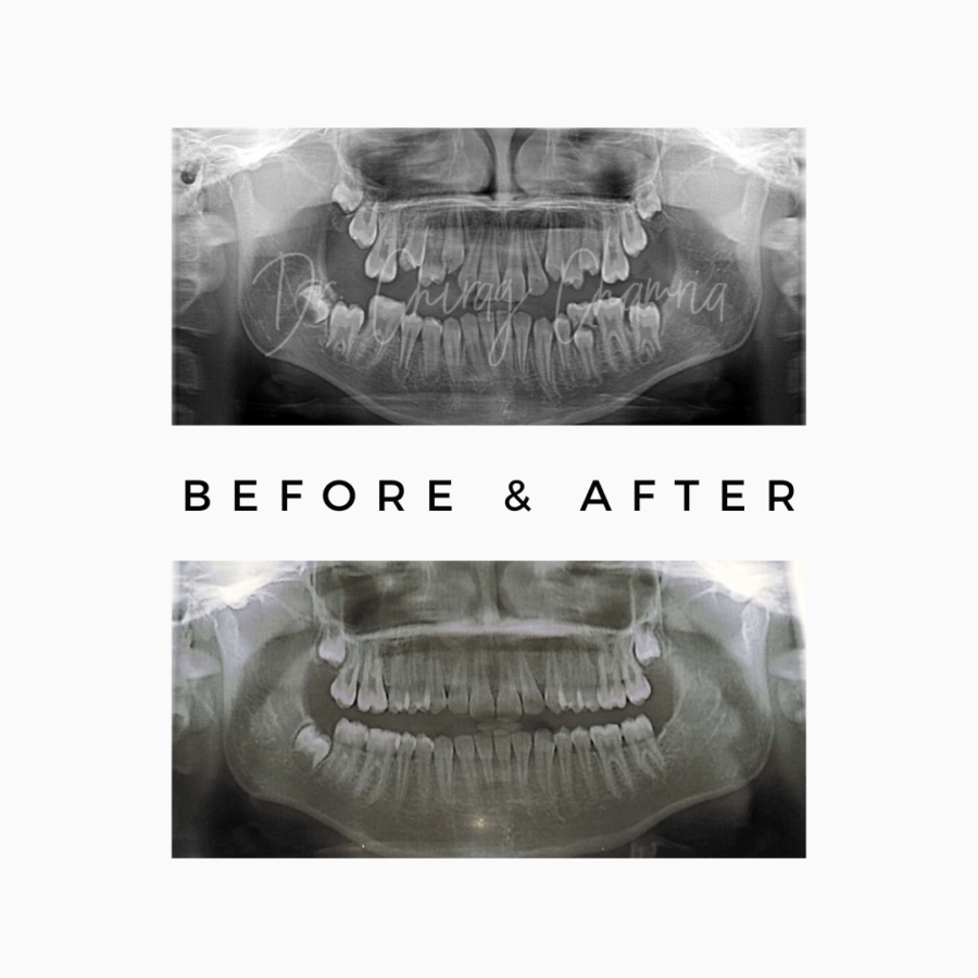 Extract Wisdom Teeth Before Braces