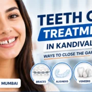 Teeth Gap Treatment In Kandivali