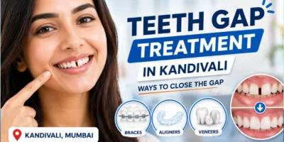 Teeth Gap Treatment In Kandivali