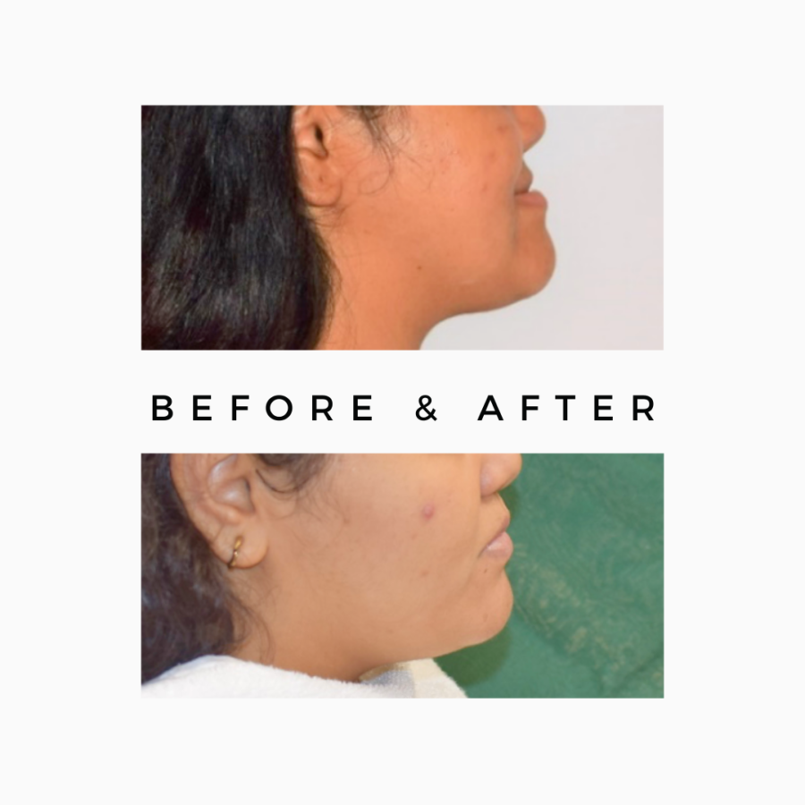 Misaligned Jaw Treatment: Jaw Correction Surgery & Orthognathic Treatment Royal Dental Clinics Orthognathic Jaw Surgery in Kandivali Mumbai
