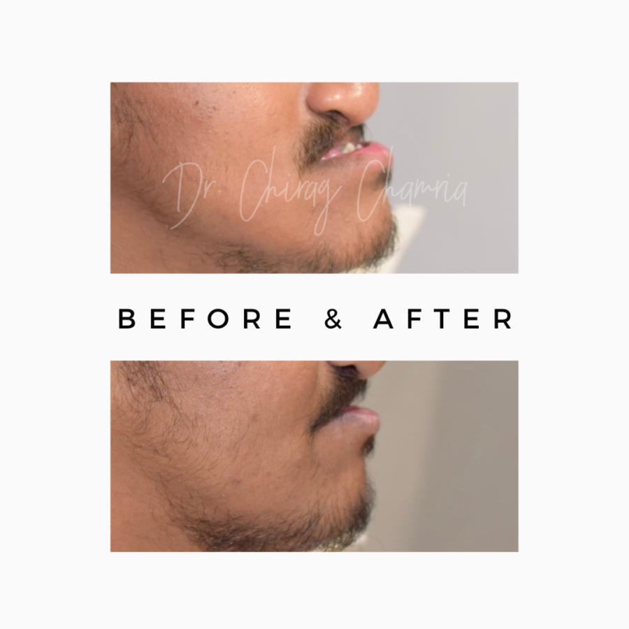 Misaligned Jaw Treatment: Jaw Correction Surgery & Orthognathic Treatment Royal Dental Clinics Jaw Surgery in Kandivali East, Mumbai