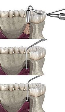 sinus-lift-types