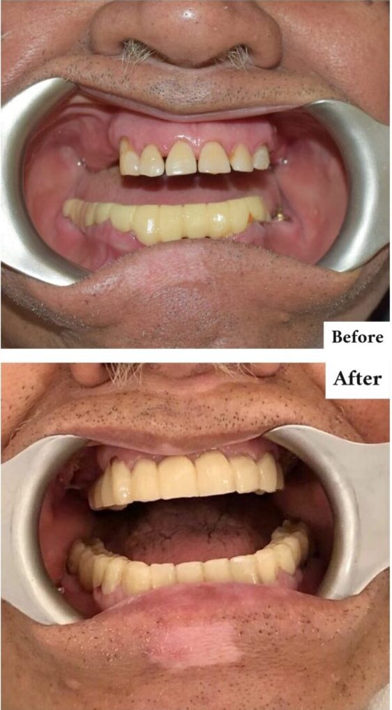 Zygomatic Dental Implant - Flapless Dental Implants