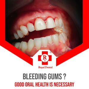 bleeding gums treatment in Mumbai