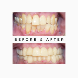 Smile Makeover in One Sitting