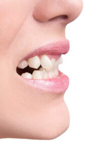 crooked teeth cosmetic dentistry